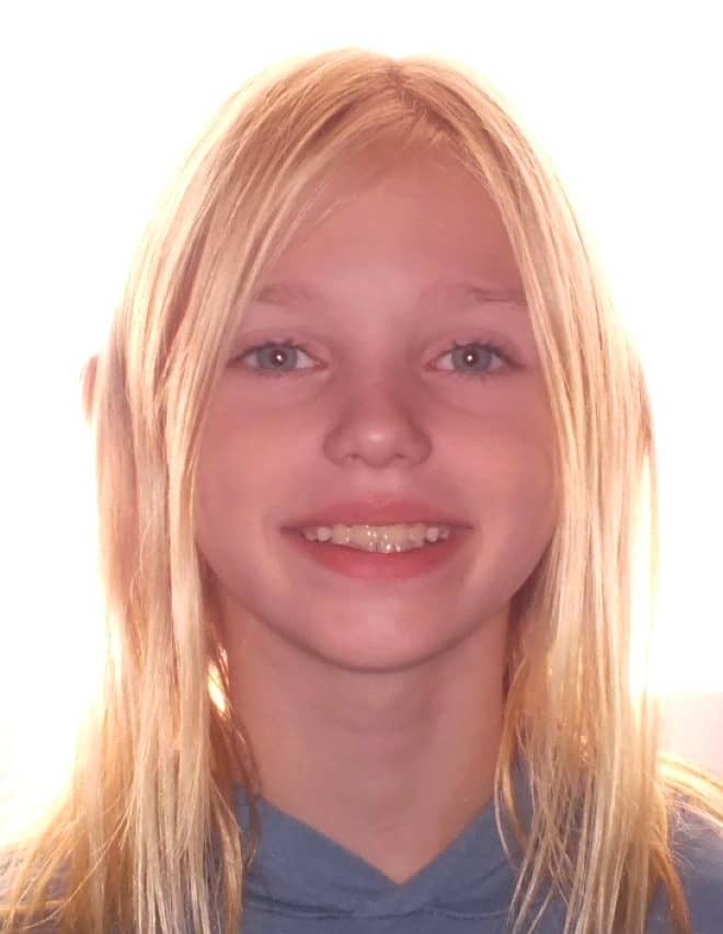 Before and After Orthodontics Photos of Emily in Carrollton Texas