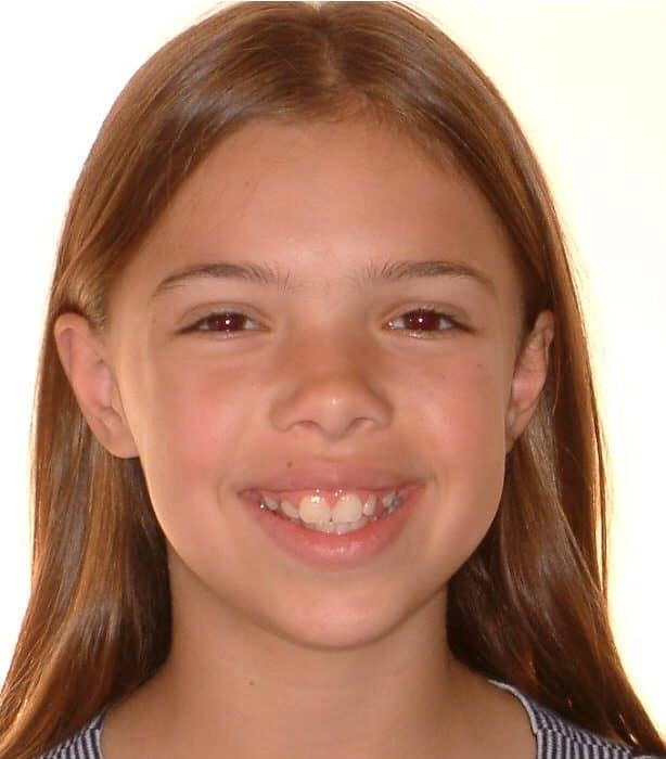 Teen's Before and After Orthodontics Photos in Carrollton Texas