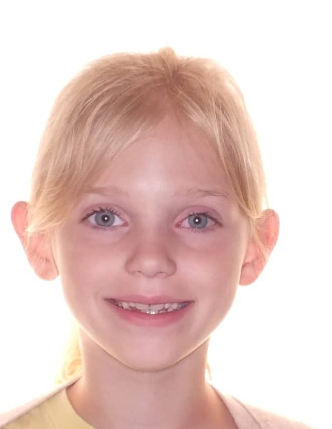 Before and After Orthodontics Photos of Emily in Carrollton Texas