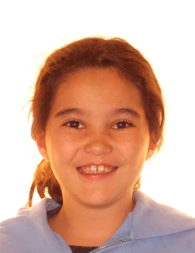 Before and After Orthodontics Photos of Noelle in Carrollton Texas