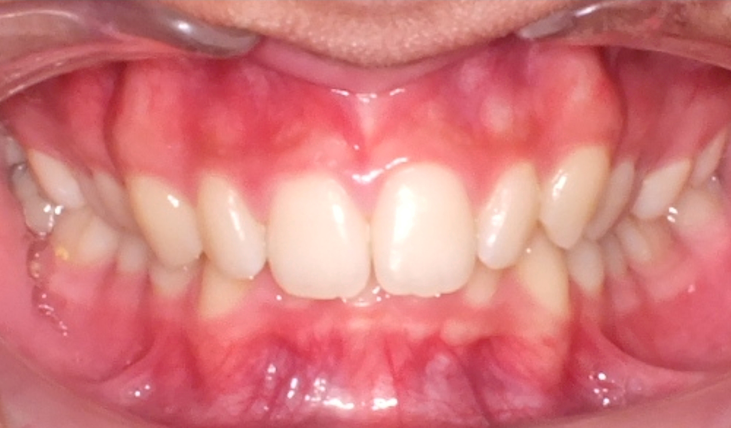 Before and After Deep Bite Photos by Patenaude Orthodontics in Carrollton Texas