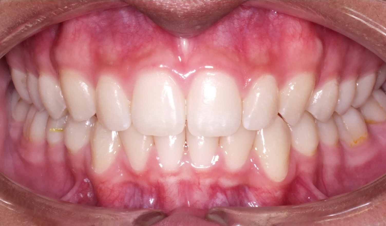 Before and After Deep Bite Photos by Patenaude Orthodontics in Carrollton Texas