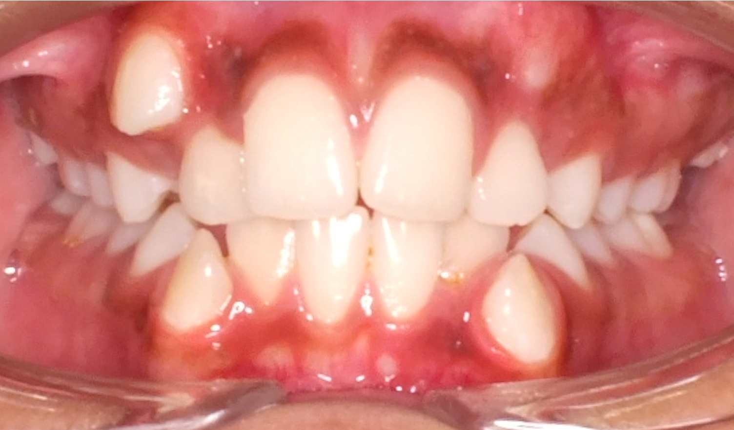Dental Crowding Before and After Photos by Patenaude Orthodontics in Carrollton Texas