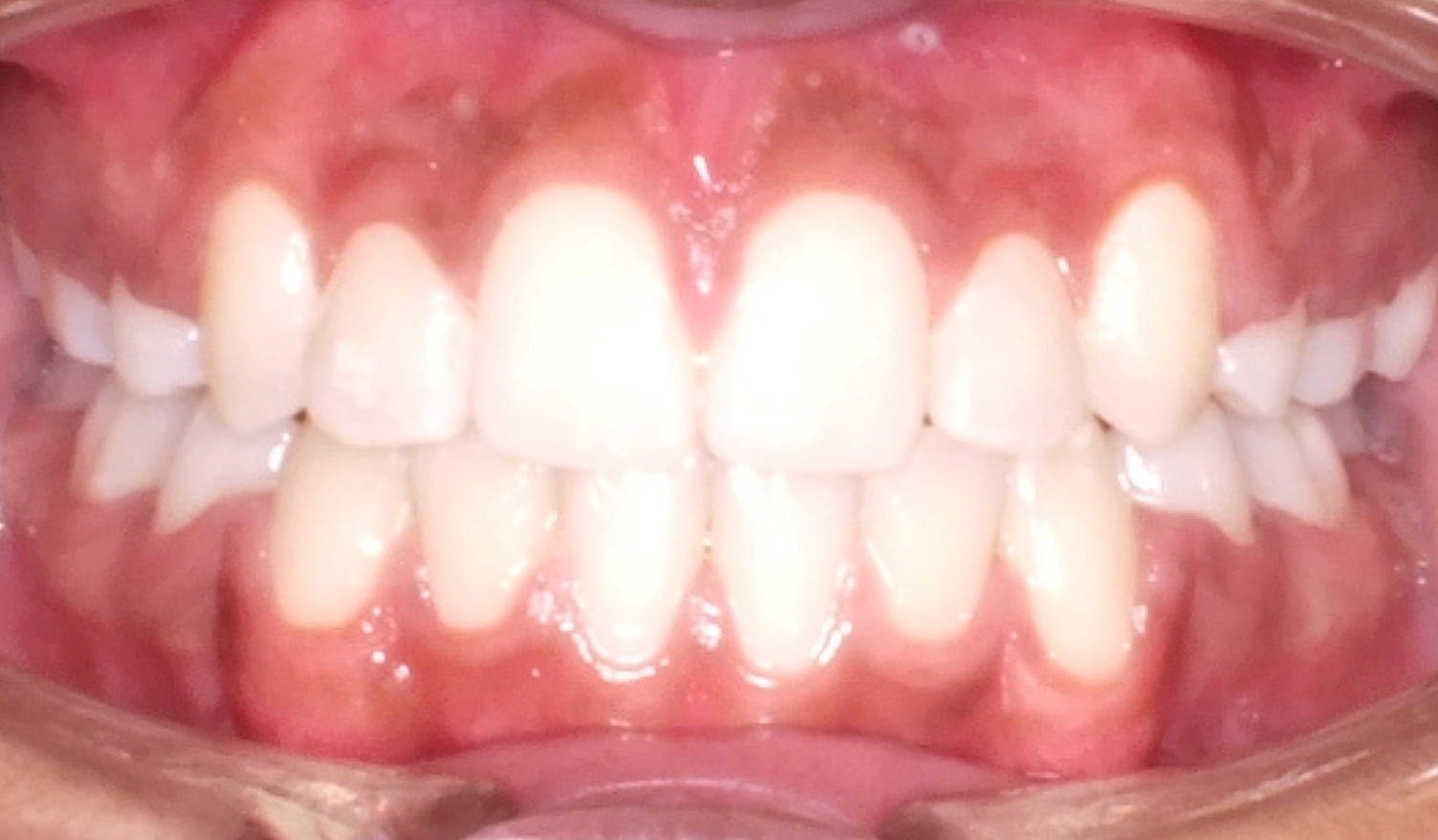 Dental Crowding Before and After Photos by Patenaude Orthodontics in Carrollton Texas