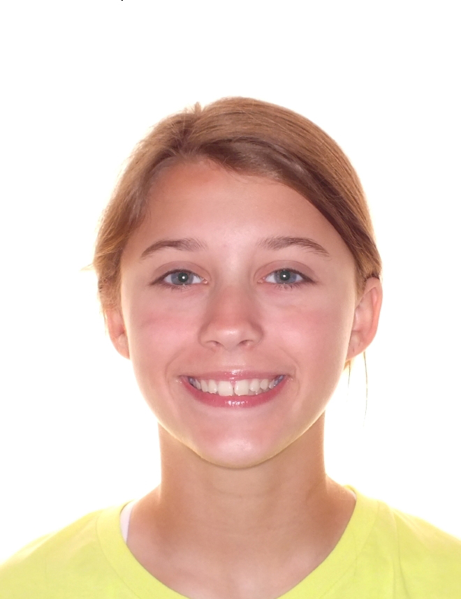 Before and After Gap Teeth Photos by Patenaude Orthodontics in Carrollton Texas