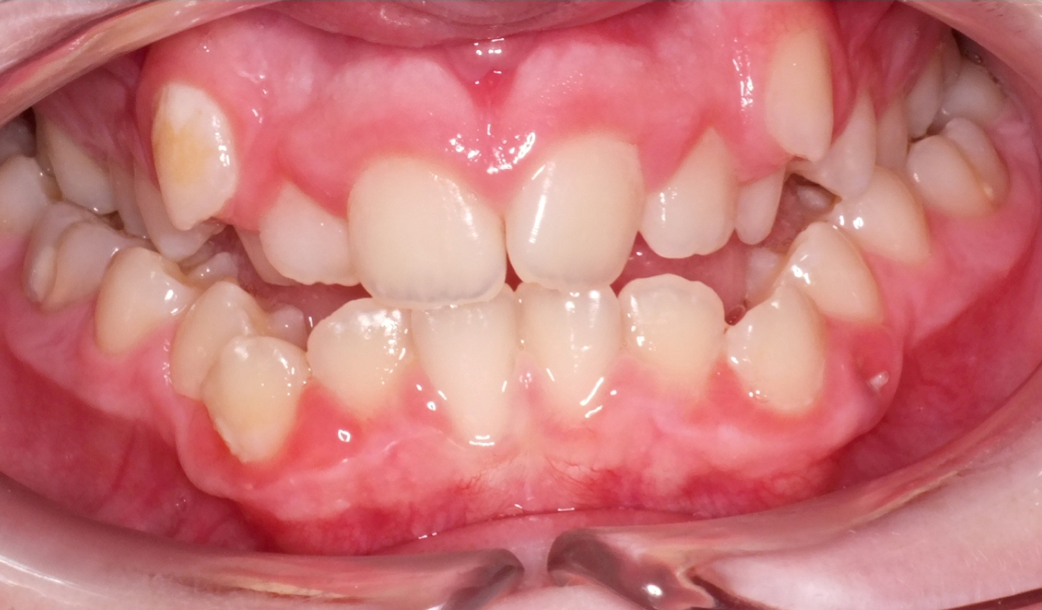Guiding Jaw Growth Before and After Photos by Patenaude Orthodontics in Carrollton Texas