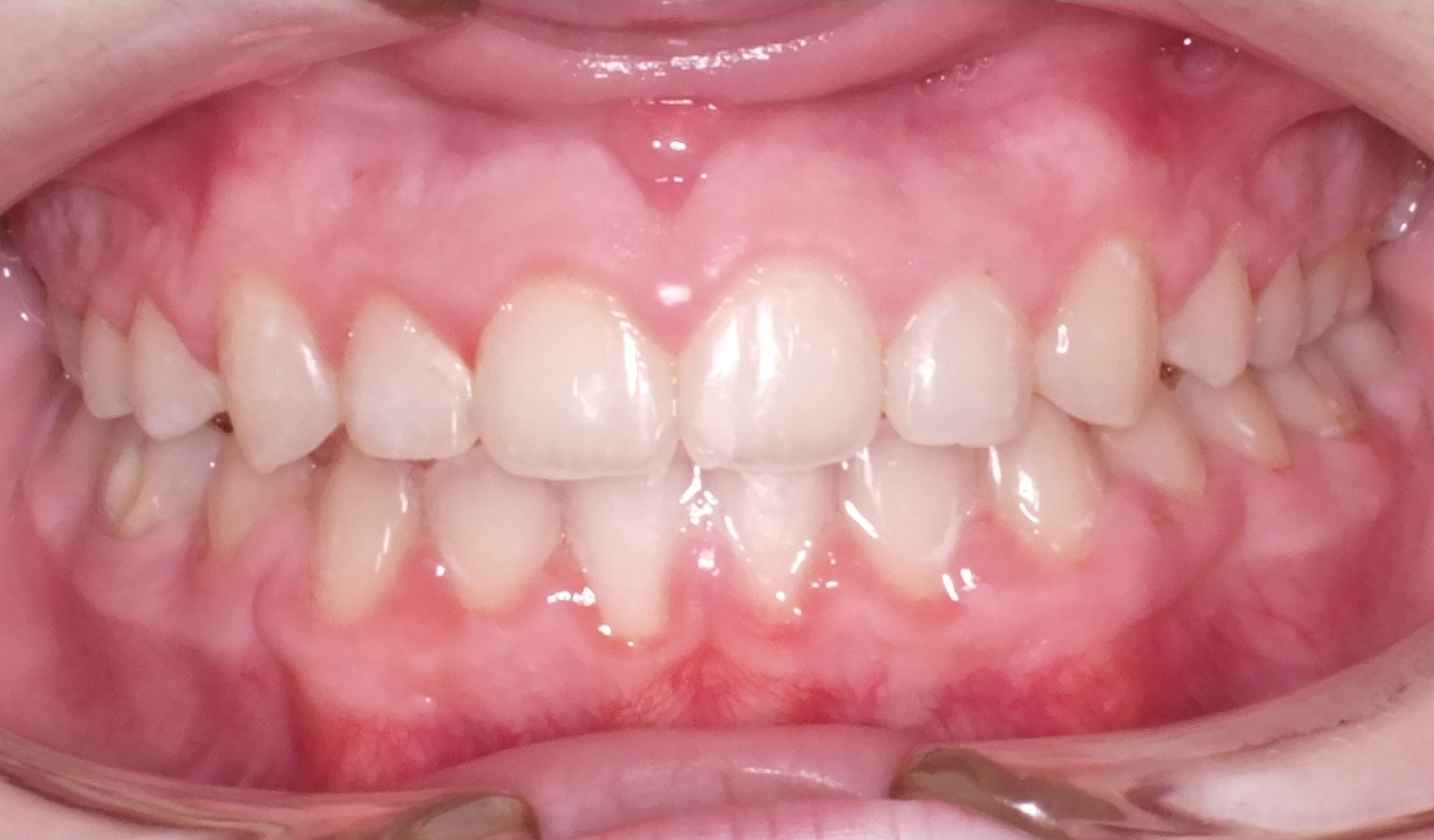 Guiding Jaw Growth Before and After Photos by Patenaude Orthodontics in Carrollton Texas