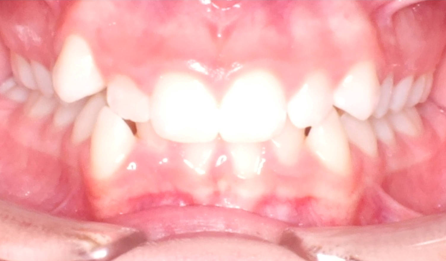 Before and After High Canine Photos by Patenaude Orthodontics in Carrollton Texas