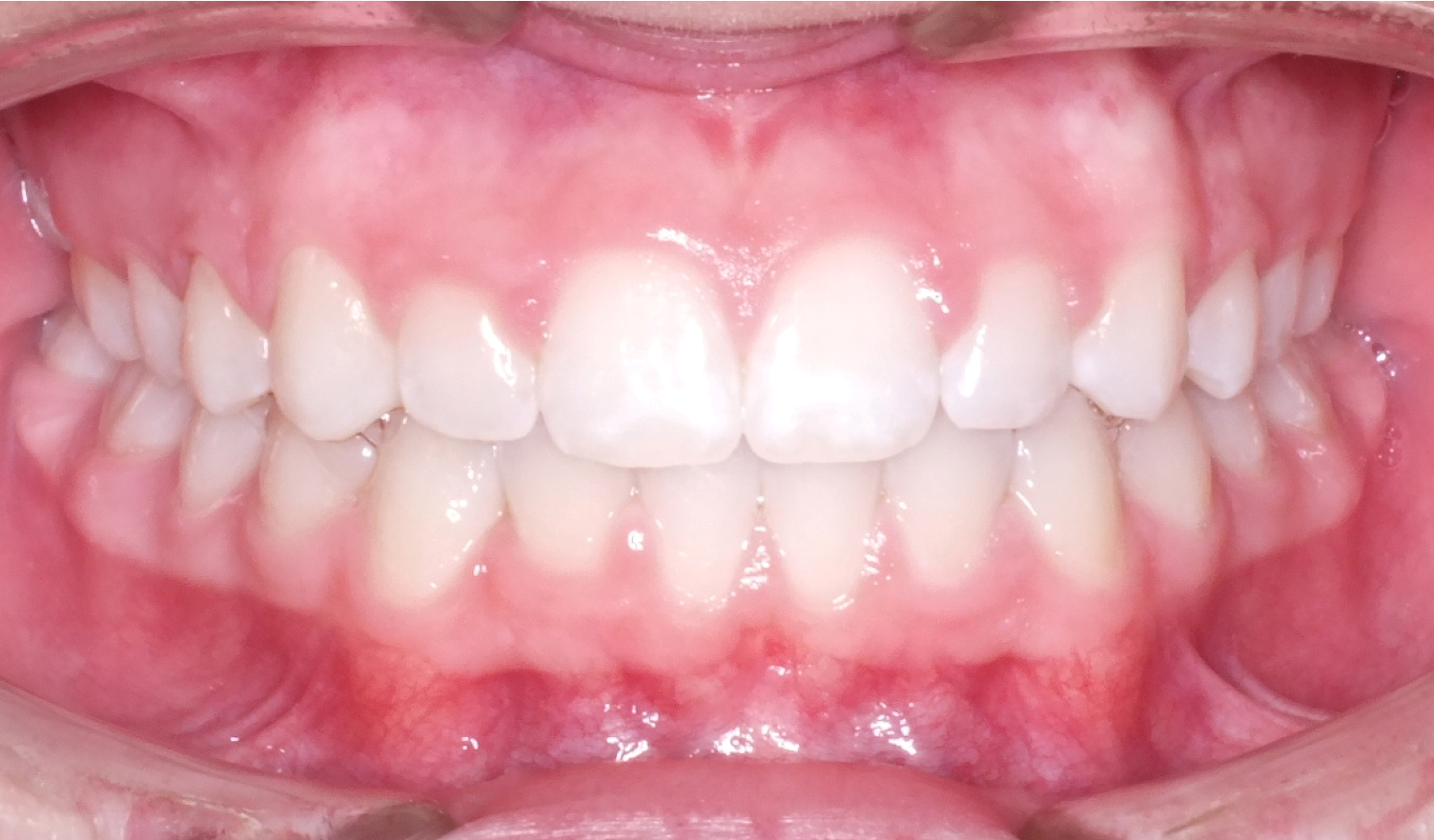 Before and After High Canine Photos by Patenaude Orthodontics in Carrollton Texas