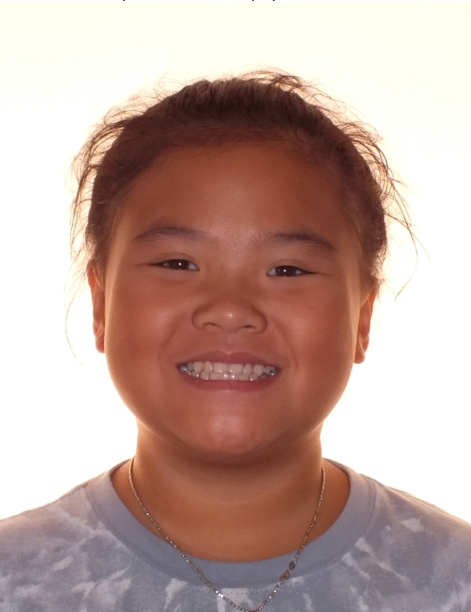 Jaw Smile Expansion Before and After Photos by Patenaude Orthodontics in Carrollton Texas