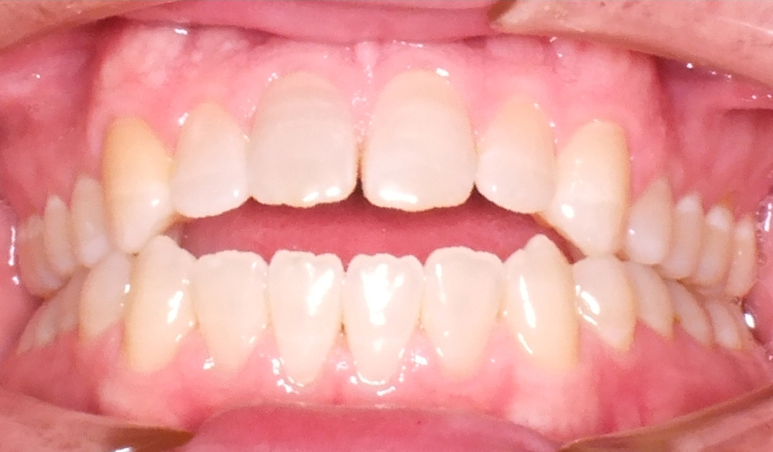 Before and After Open Bite Photos by Patenaude Orthodontics in Carrollton Texas