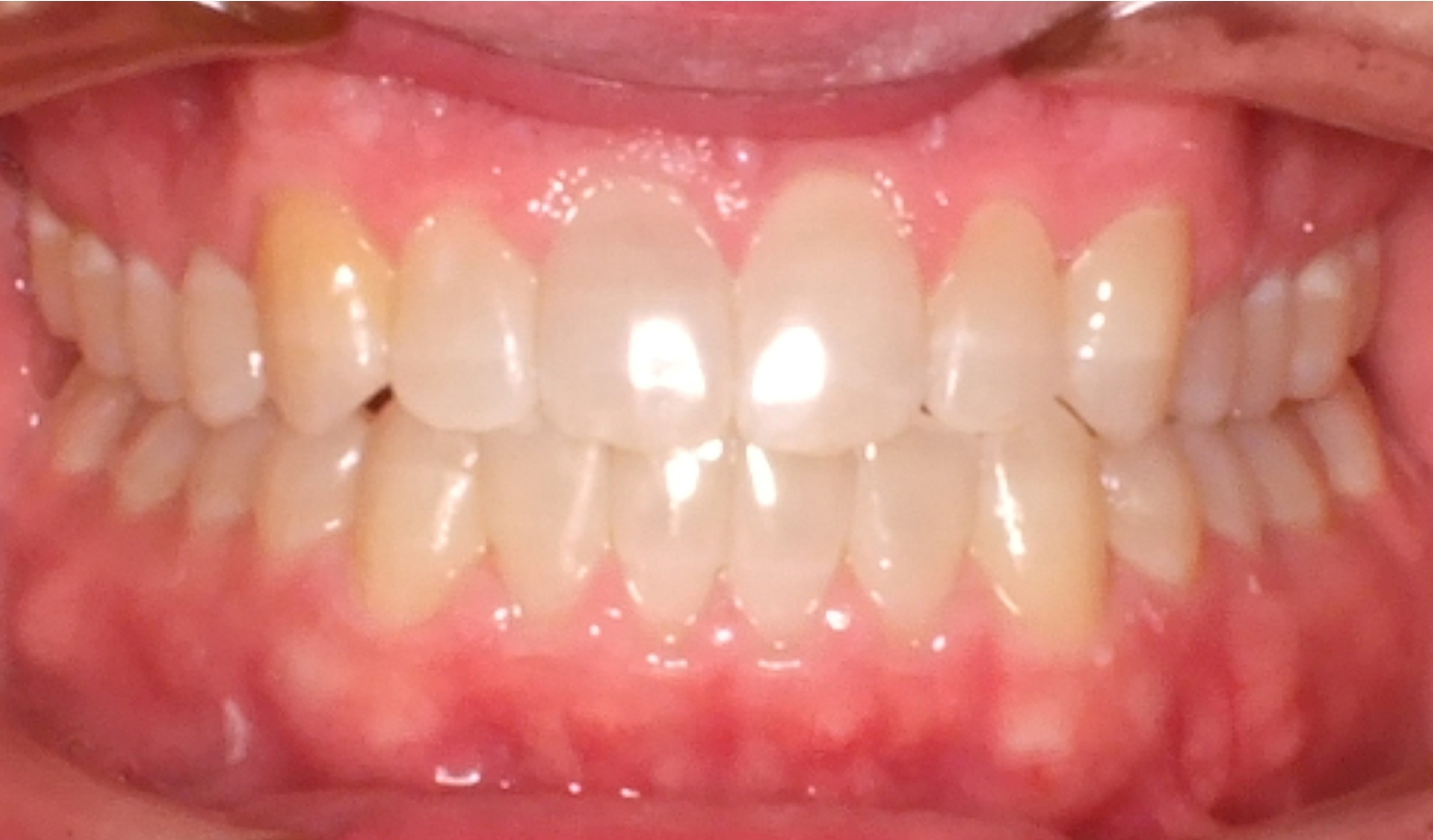 Before and After Open Bite Photos by Patenaude Orthodontics in Carrollton Texas