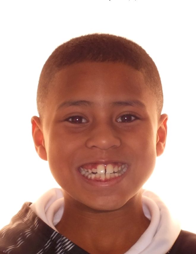 Before and After Teeth Photos by Patenaude Orthodontics in Carrollton Texas