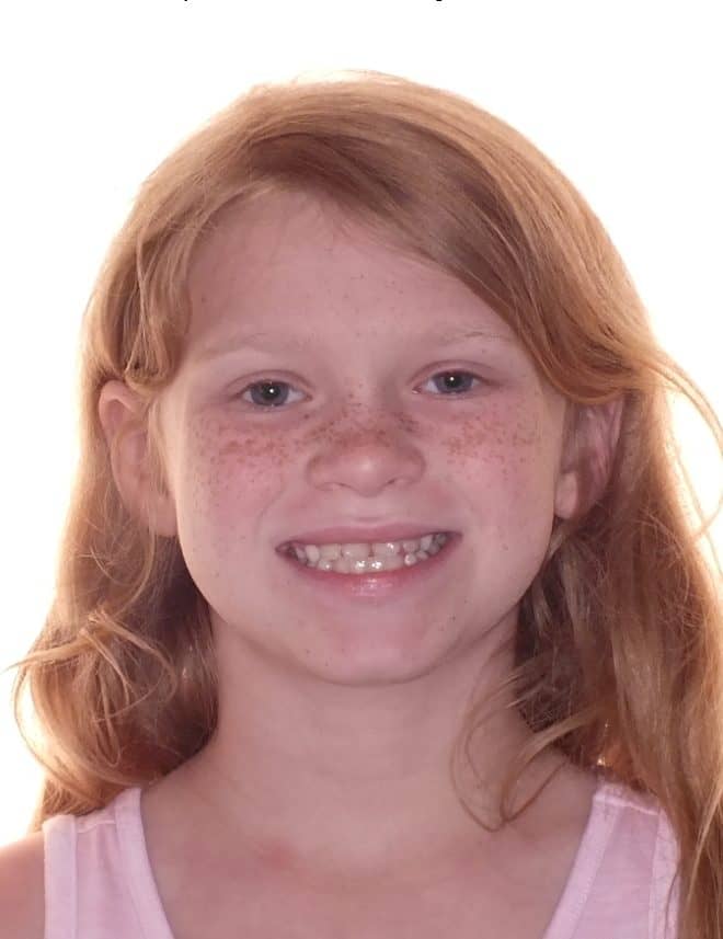 Raelan's Before and After Orthodontics Photos in Carrollton Texas