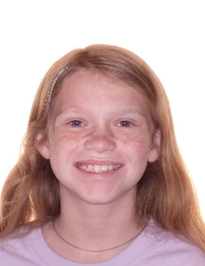 Raelan's Before and After Orthodontics Photos in Carrollton Texas