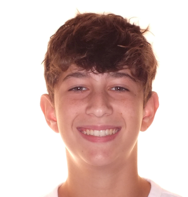 Before and after teenager teeth photos by Dr. Patenaude Orthodontics in Carrollton TX. Serving all of Dallas County, Denton County, and Collin County.