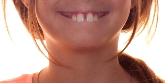 Before and after child teeth photos by Dr. Patenaude Orthodontics in Carrollton TX. Serving all of Dallas County, Denton County, and Collin County.