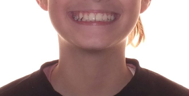 Before and after child teeth photos by Dr. Patenaude Orthodontics in Carrollton TX. Serving all of Dallas County, Denton County, and Collin County.