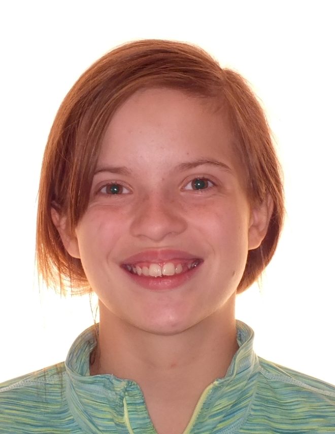 Before and after teenager teeth photos by Dr. Patenaude Orthodontics in Carrollton TX. Serving all of Dallas County, Denton County, and Collin County.