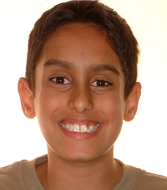 Before and after teenager teeth photos by Dr. Patenaude Orthodontics in Carrollton TX. Serving all of Dallas County, Denton County, and Collin County.